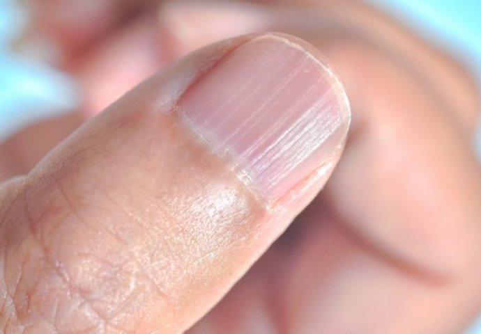 Šta znače izbočine na noktima? Saznajte više o njihovom značaju za zdravlje